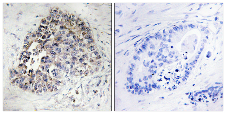 CYP2S1 Antibody - Immunohistochemistry analysis of paraffin-embedded human lung carcinoma tissue, using Cytochrome P450 2S1 Antibody. The picture on the right is blocked with the synthesized peptide.