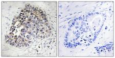 CYP2S1 Antibody - Peptide - + Immunohistochemistry analysis of paraffin-embedded human lung carcinoma tissue using Cytochrome P450 2S1 antibody.