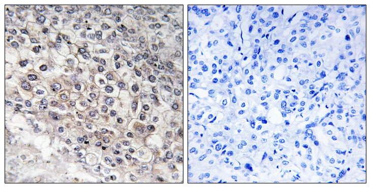 CYP2W1 Antibody - Immunohistochemistry analysis of paraffin-embedded human liver carcinoma tissue, using Cytochrome P450 2W1 Antibody. The picture on the right is blocked with the synthesized peptide.