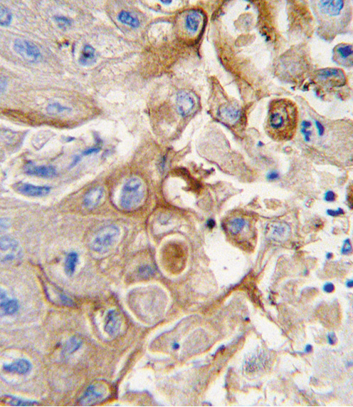 CYP2W1 Antibody - Formalin-fixed and paraffin-embedded human lung carcinoma tissue reacted with CYP2W1 antibody , which was peroxidase-conjugated to the secondary antibody, followed by DAB staining. This data demonstrates the use of this antibody for immunohistochemistry; clinical relevance has not been evaluated.
