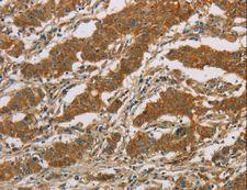 CYP39A1 Antibody - Immunohistochemistry of paraffin-embedded Human gastric cancer using CYP39A1 Polyclonal Antibody at dilution of 1:50.