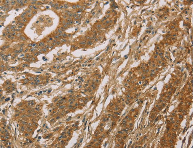 CYP39A1 Antibody - Immunohistochemistry of paraffin-embedded Human thyroid cancer using CYP39A1 Polyclonal Antibody at dilution of 1:50.