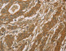 CYP39A1 Antibody - Immunohistochemistry of paraffin-embedded Human thyroid cancer using CYP39A1 Polyclonal Antibody at dilution of 1:50.