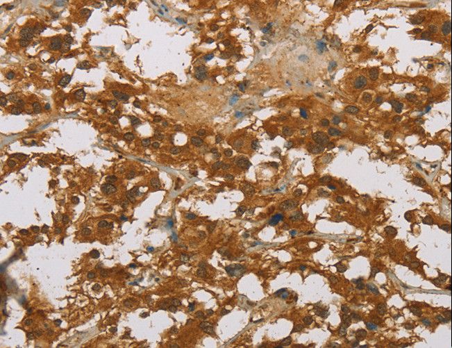 CYP39A1 Antibody - Immunohistochemistry of paraffin-embedded Human thyroid cancer using CYP39A1 Polyclonal Antibody at dilution of 1:50.