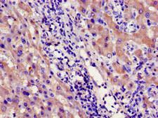 CYP39A1 Antibody - Immunohistochemistry image of paraffin-embedded human liver cancer at a dilution of 1:100