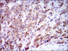 CYP3A4 / Cytochrome P450 3A4 Antibody - IHC of paraffin-embedded liver cancer tissues using CYP3A4 mouse monoclonal antibody with DAB staining.