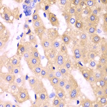 CYP3A4 / Cytochrome P450 3A4 Antibody - Immunohistochemistry of paraffin-embedded human liver cancer using CYP3A4 antibody at dilution of 1:100 (40x lens).