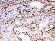CYP3A4 / Cytochrome P450 3A4 Antibody - IHC testing of FFPE human liver cancer tissue with CYP3A4 antibody at 1ug/ml. HIER: steam section in pH6 citrate buffer for 20 min.