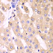 CYP3A4 / Cytochrome P450 3A4 Antibody - Immunohistochemistry of paraffin-embedded Human liver cancer using CYP3A4 Polyclonal Antibody at dilution of 1:100 (40x lens).