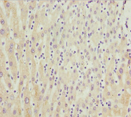 CYP3A43 Antibody - Immunohistochemistry of paraffin-embedded human liver cancer at dilution 1:100