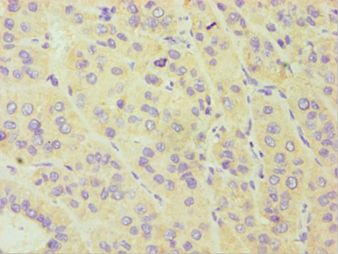CYP3A5 Antibody - Immunohistochemistry of paraffin-embedded human liver cancer using antibody at 1:100 dilution.