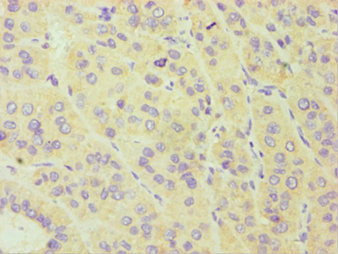 CYP3A5 Antibody - Immunohistochemistry of paraffin-embedded human liver cancer using CYP3A5 Antibody at dilution of 1:100