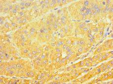 CYP4A11 Antibody - Immunohistochemistry of paraffin-embedded human liver cancer using antibody at 1:100 dilution.