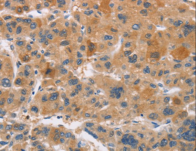 CYP4A11 Antibody - Immunohistochemistry of paraffin-embedded Human liver cancer using CYP4A11 Polyclonal Antibody at dilution of 1:30.