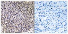 CYP4B1 Antibody - Immunohistochemistry analysis of paraffin-embedded human lung carcinoma tissue, using Cytochrome P450 4B1 Antibody. The picture on the right is blocked with the synthesized peptide.