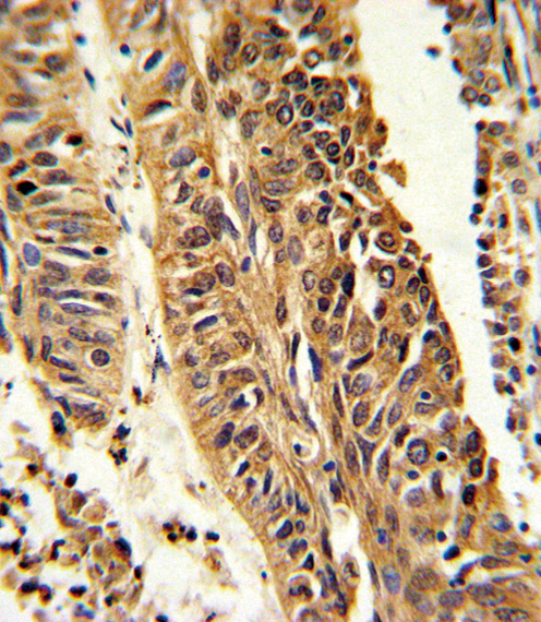 CYP4B1 Antibody - Formalin-fixed and paraffin-embedded human lung carcinoma reacted with CYP4B1 Antibody , which was peroxidase-conjugated to the secondary antibody, followed by DAB staining. This data demonstrates the use of this antibody for immunohistochemistry; clinical relevance has not been evaluated.