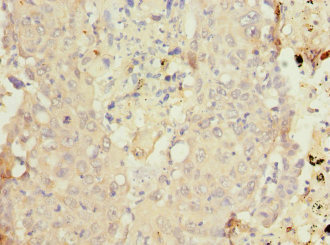 CYP4B1 Antibody - Immunohistochemistry of paraffin-embedded human lung cancer at dilution 1:100