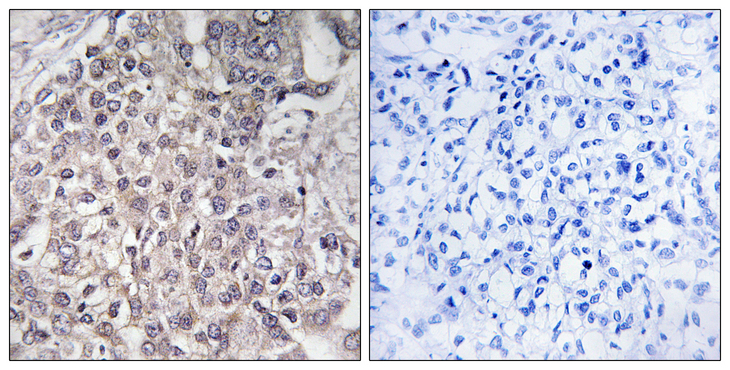CYP4F2 Antibody - Immunohistochemistry analysis of paraffin-embedded human liver carcinoma, using Cytochrome P450 4F2 Antibody. The picture on the right is blocked with the synthesized peptide.