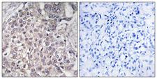 CYP4F2 Antibody - Peptide - + Immunohistochemistry analysis of paraffin-embedded human liver carcinoma tissue using Cytochrome P450 4F2 antibody.