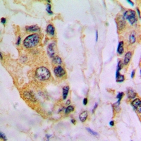 CYP4V2 Antibody - Immunohistochemical analysis of Cytochrome P450 4V2 staining in human breast cancer formalin fixed paraffin embedded tissue section. The section was pre-treated using heat mediated antigen retrieval with sodium citrate buffer (pH 6.0). The section was then incubated with the antibody at room temperature and detected using an HRP conjugated compact polymer system. DAB was used as the chromogen. The section was then counterstained with haematoxylin and mounted with DPX.