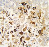 CYP4X1 Antibody - Formalin-fixed and paraffin-embedded human lung carcinoma tissue reacted with CYP4X1 antibody , which was peroxidase-conjugated to the secondary antibody, followed by DAB staining. This data demonstrates the use of this antibody for immunohistochemistry; clinical relevance has not been evaluated.