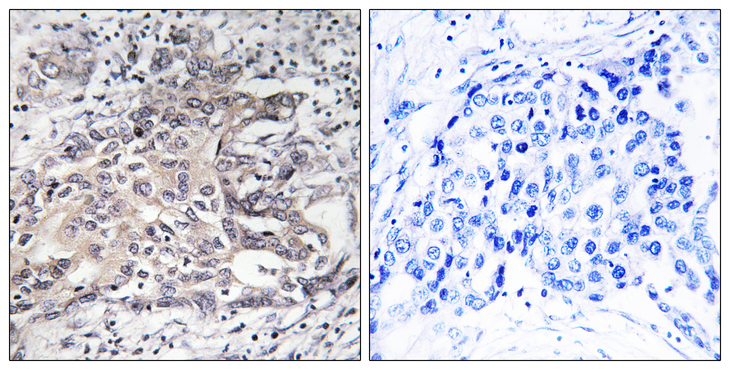 CYP4X1 Antibody - Immunohistochemistry analysis of paraffin-embedded human liver carcinoma tissue, using Cytochrome P450 4X1 Antibody. The picture on the right is blocked with the synthesized peptide.