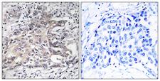 CYP4X1 Antibody - Immunohistochemistry analysis of paraffin-embedded human liver carcinoma tissue, using Cytochrome P450 4X1 Antibody. The picture on the right is blocked with the synthesized peptide.