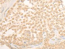CYP4X1 Antibody - Immunohistochemistry of paraffin-embedded Human ovarian cancer tissue  using CYP4X1 Polyclonal Antibody at dilution of 1:40(×200)