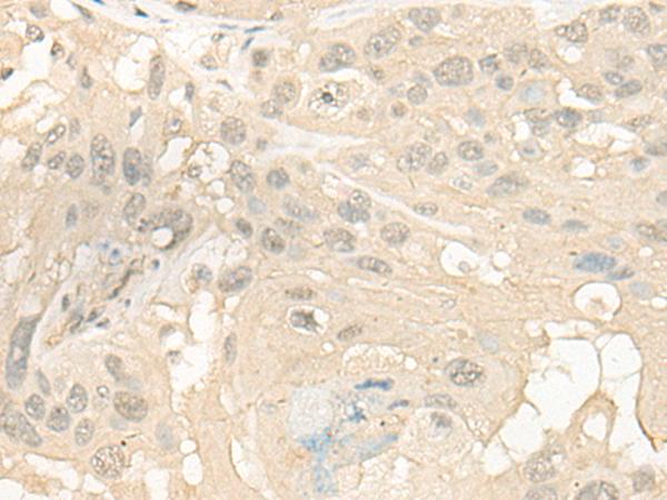 CYP4X1 Antibody - Immunohistochemistry of paraffin-embedded Human esophagus cancer tissue  using CYP4X1 Polyclonal Antibody at dilution of 1:40(×200)