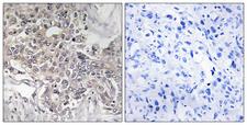 CYP4Z1 Antibody - Immunohistochemistry analysis of paraffin-embedded human liver carcinoma tissue, using Cytochrome P450 4Z1 Antibody. The picture on the right is blocked with the synthesized peptide.