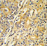 CYP51A1 / CYP51 Antibody - Formalin-fixed and paraffin-embedded human prostate carcinoma reacted with CYP51A1 Antibody , which was peroxidase-conjugated to the secondary antibody, followed by DAB staining. This data demonstrates the use of this antibody for immunohistochemistry; clinical relevance has not been evaluated.