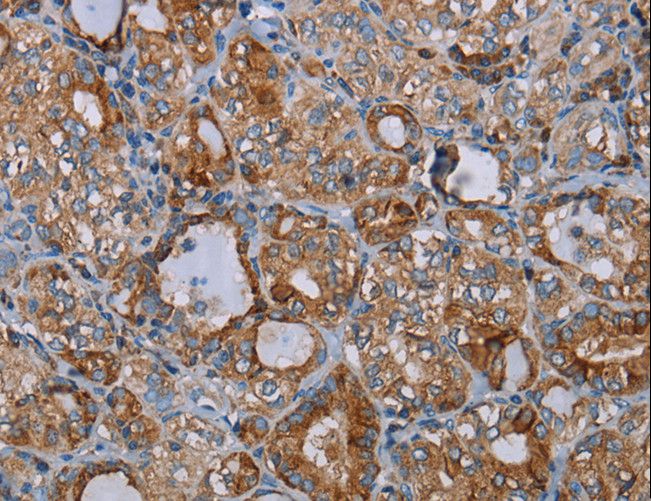 CYP7A1 Antibody - Immunohistochemistry of paraffin-embedded Human thyroid cancer using CYP7A1 Polyclonal Antibody at dilution of 1:20.