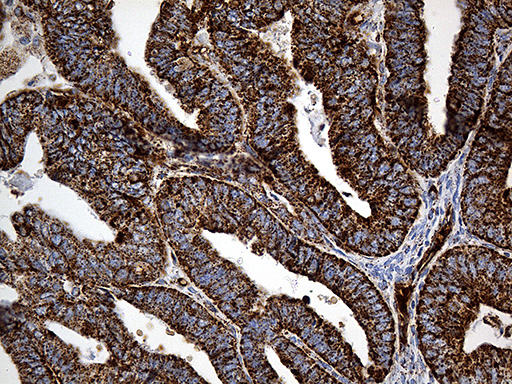 CYP7B1 Antibody - Immunohistochemical staining of paraffin-embedded Adenocarcinoma of Human endometrium tissue using anti-CYP7B1 mouse monoclonal antibody. (Heat-induced epitope retrieval by 1mM EDTA in 10mM Tris buffer. (pH8.5) at 120°C for 3 min. (1:500)