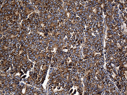 CYP7B1 Antibody - Immunohistochemical staining of paraffin-embedded Adenocarcinoma of Human breast tissue tissue using anti-CYP7B1 mouse monoclonal antibody. (Heat-induced epitope retrieval by 1mM EDTA in 10mM Tris buffer. (pH8.5) at 120°C for 3 min. (1:500)