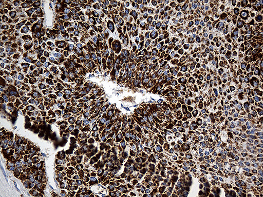 CYP7B1 Antibody - Immunohistochemical staining of paraffin-embedded Carcinoma of Human liver tissue using anti-CYP7B1 mouse monoclonal antibody. (Heat-induced epitope retrieval by 1mM EDTA in 10mM Tris buffer. (pH8.5) at 120°C for 3 min. (1:500)
