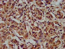 CYP8B1 Antibody - Immunohistochemistry image at a dilution of 1:300 and staining in paraffin-embedded human liver cancer performed on a Leica BondTM system. After dewaxing and hydration, antigen retrieval was mediated by high pressure in a citrate buffer (pH 6.0) . Section was blocked with 10% normal goat serum 30min at RT. Then primary antibody (1% BSA) was incubated at 4 °C overnight. The primary is detected by a biotinylated secondary antibody and visualized using an HRP conjugated SP system.