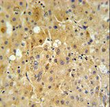 CYPOR / POR Antibody - P450R Antibody IHC of formalin-fixed and paraffin-embedded human hepatocarcinoma tissue followed by peroxidase-conjugated secondary antibody and DAB staining.