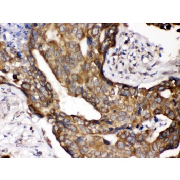 CYPOR / POR Antibody - POR antibody IHC-paraffin. IHC(P): Human Mammary Cancer Tissue.