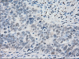 CYPOR / POR Antibody - Immunohistochemical staining of paraffin-embedded Adenocarcinoma of ovary tissue using anti-POR mouse monoclonal antibody. (Dilution 1:50).