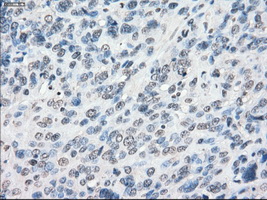 CYPOR / POR Antibody - Immunohistochemical staining of paraffin-embedded Carcinoma of bladder tissue using anti-POR mouse monoclonal antibody. (Dilution 1:50).