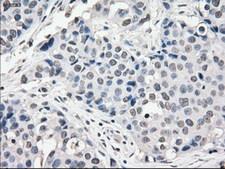CYPOR / POR Antibody - IHC of paraffin-embedded Adenocarcinoma of breast tissue using anti-POR mouse monoclonal antibody. (Dilution 1:50).