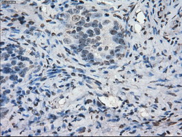 CYPOR / POR Antibody - IHC of paraffin-embedded Adenocarcinoma of ovary tissue using anti-POR mouse monoclonal antibody. (Dilution 1:50).