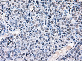 CYPOR / POR Antibody - IHC of paraffin-embedded Adenocarcinoma of endometrium tissue using anti-POR mouse monoclonal antibody. (Dilution 1:50).