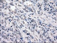 CYPOR / POR Antibody - IHC of paraffin-embedded Adenocarcinoma of colon tissue using anti-POR mouse monoclonal antibody. (Dilution 1:50).