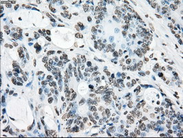 CYPOR / POR Antibody - IHC of paraffin-embedded Adenocarcinoma of colon tissue using anti-POR mouse monoclonal antibody. (Dilution 1:50).