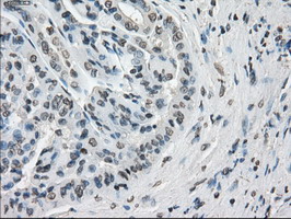 CYPOR / POR Antibody - IHC of paraffin-embedded Carcinoma of kidney tissue using anti-POR mouse monoclonal antibody. (Dilution 1:50).