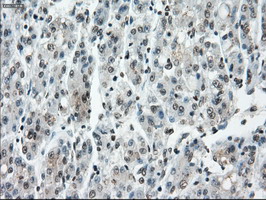 CYPOR / POR Antibody - IHC of paraffin-embedded Carcinoma of liver tissue using anti-POR mouse monoclonal antibody. (Dilution 1:50).