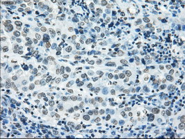 CYPOR / POR Antibody - IHC of paraffin-embedded Carcinoma of lung tissue using anti-POR mouse monoclonal antibody. (Dilution 1:50).