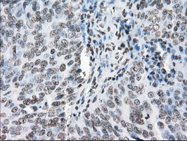 CYPOR / POR Antibody - IHC of paraffin-embedded Adenocarcinoma of ovary tissue using anti-POR mouse monoclonal antibody. (Dilution 1:50).