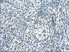 CYPOR / POR Antibody - IHC of paraffin-embedded Carcinoma of thyroid tissue using anti-POR mouse monoclonal antibody. (Dilution 1:50).